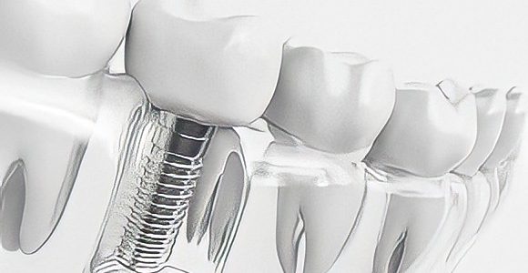 Dental Implants - Pic for text